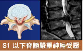 馬尾神經受壓